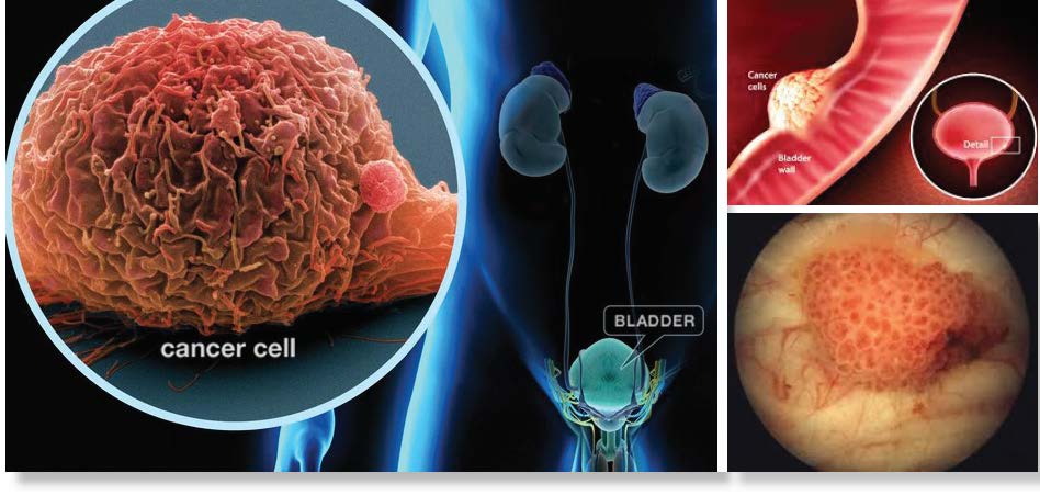 Bladder Cancer